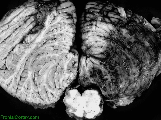 Hemorrhagic infarct, transverse section through cerebellum and medulla.
